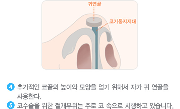 4. 추가적인 코끝의 높이와 모양을 얻기 위해서 자가 귀 연골을 사용한다. 
5. 코수술을 위한 절개부위는 주로 코 속으로 시행하고 있습니다.