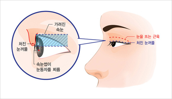 커튼눈 증후군이란?